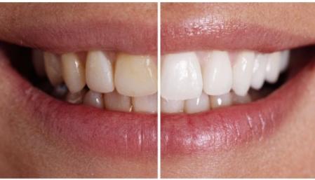 Avant et après l'utilisation du dentifrice Bioniq® White Filler